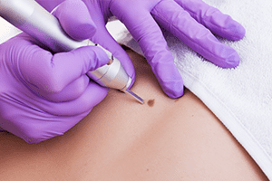 Mole Evaluation and Removal