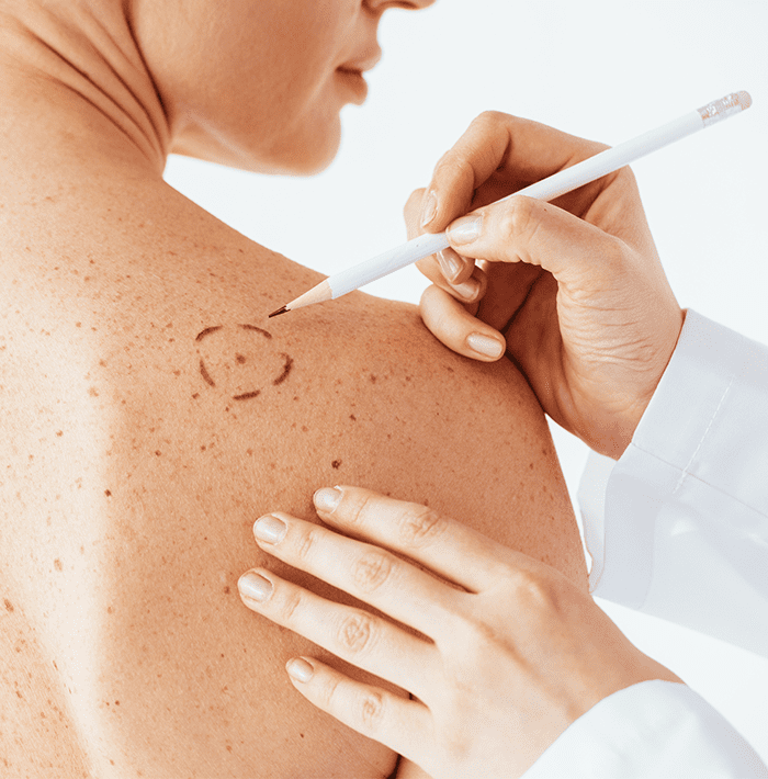 Mohssurgery12 Mohs Skin Cancer Surgery in Salem, OR