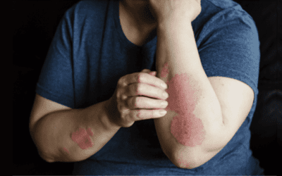 Psoriasis Explained: Managing This Chronic Skin Condition