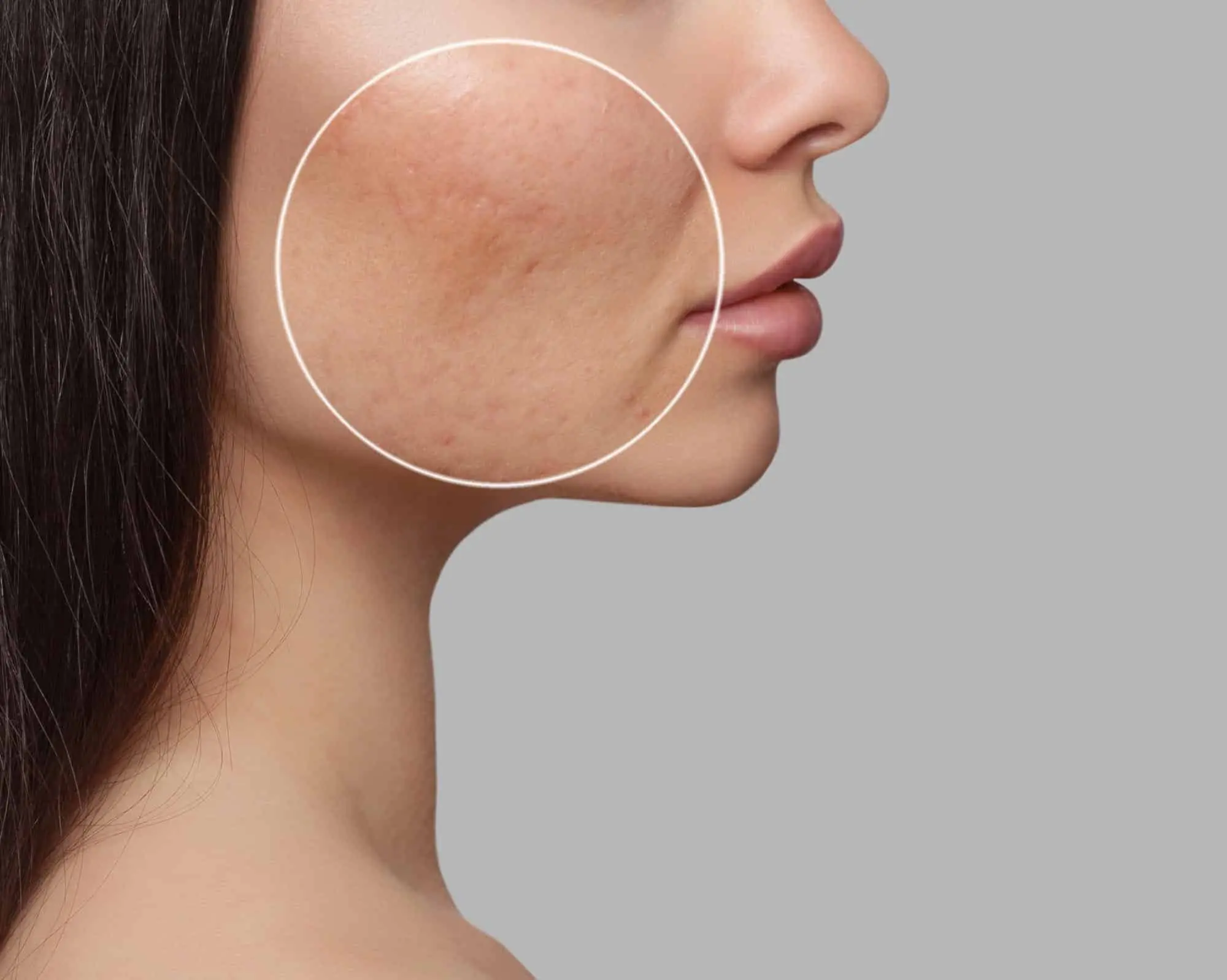 How Can I Treat My Facial Scars?