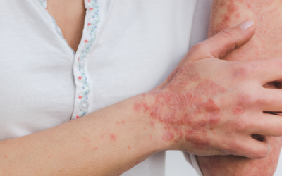 Psoriasis Awareness Month: Understanding Your Skin, Finding Real Relief