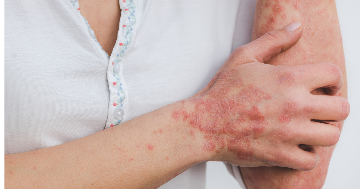 Psoriasis Awareness Month: Understanding Your Skin, Finding Real Relief