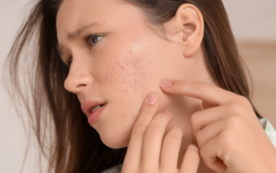 Teen Acne, Handled: A Back-to-School Guide for Clearer Skin