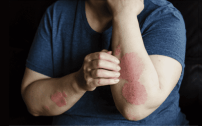Psoriasis Explained: Managing This Chronic Skin Condition