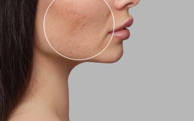 How Can I Treat My Facial Scars?